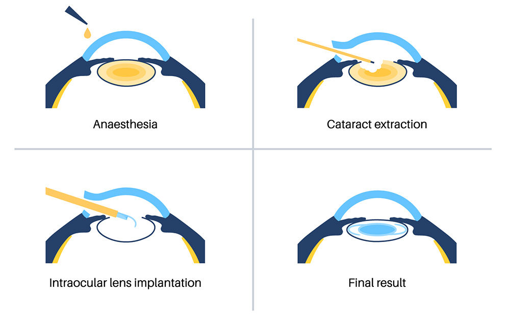 Understanding Cataracts: When Cloudy Vision Doesn't Have to Be Your Future